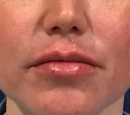 Lip Injections Case 37 After Image
