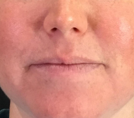 Lip Injections Case 37 Before Image