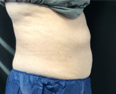 Coolsculpting® ELITE Case 50 After Image