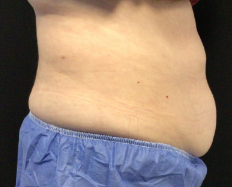 Coolsculpting® ELITE Case 50 Before Image