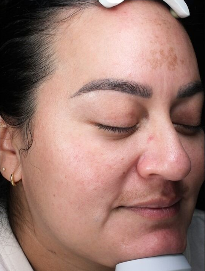 SkinPen® Microneedling Case 2 After Image