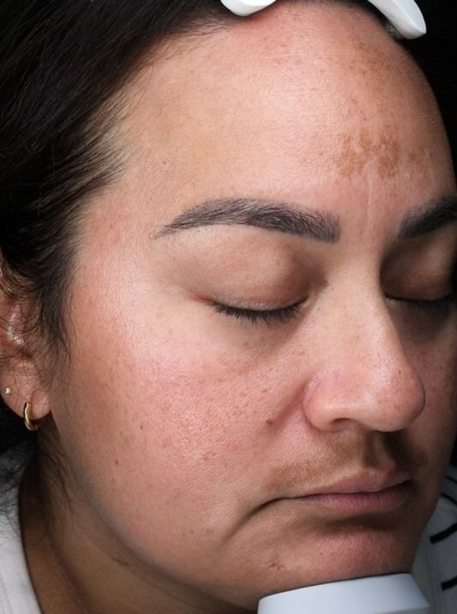 SkinPen® Microneedling Case 2 Before Image