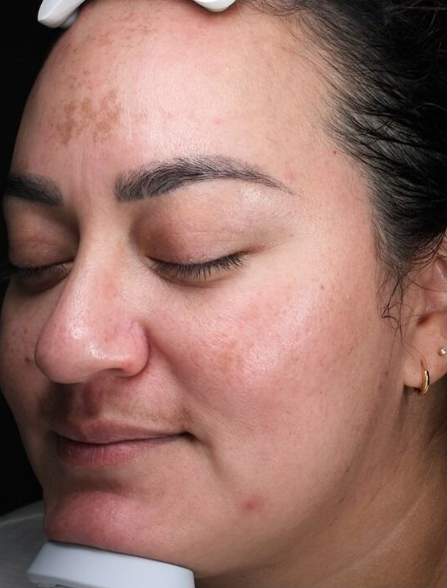 SkinPen® Microneedling Case 2 After Image