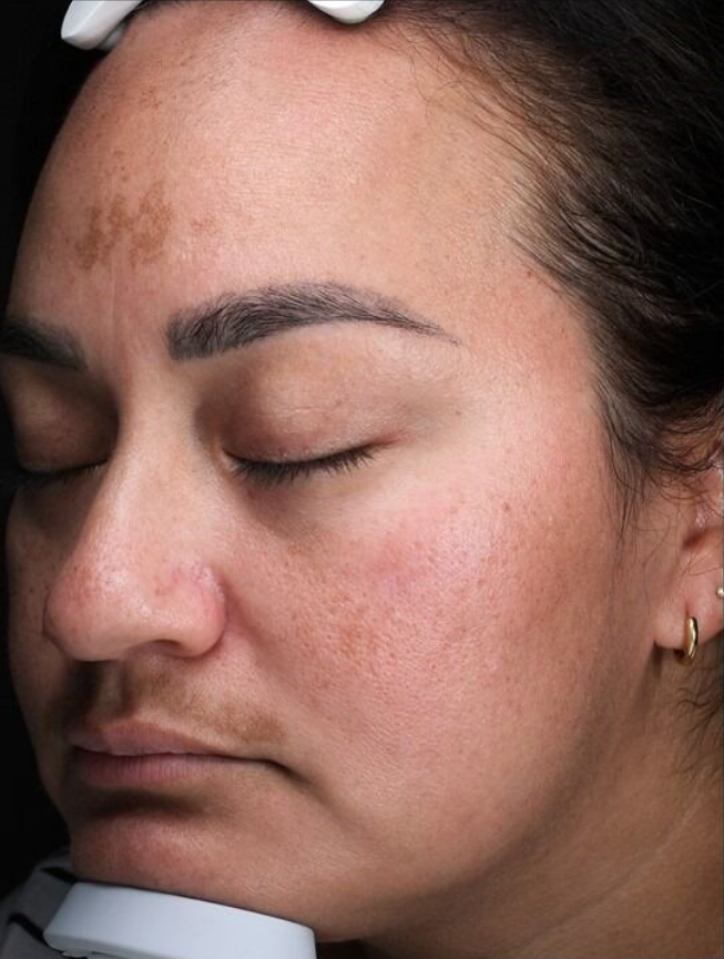 SkinPen® Microneedling Case 2 Before Image