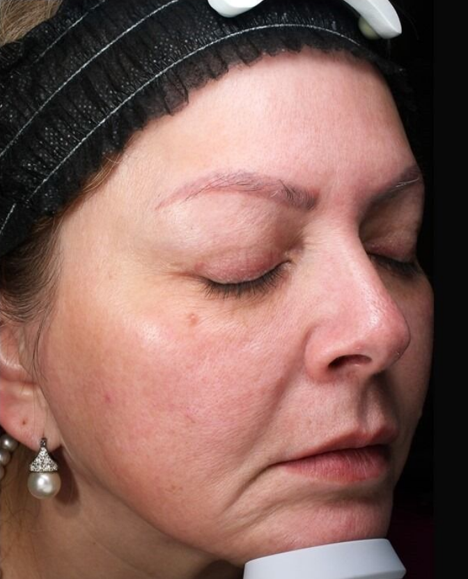 BBL Therapy Case 10 After Image