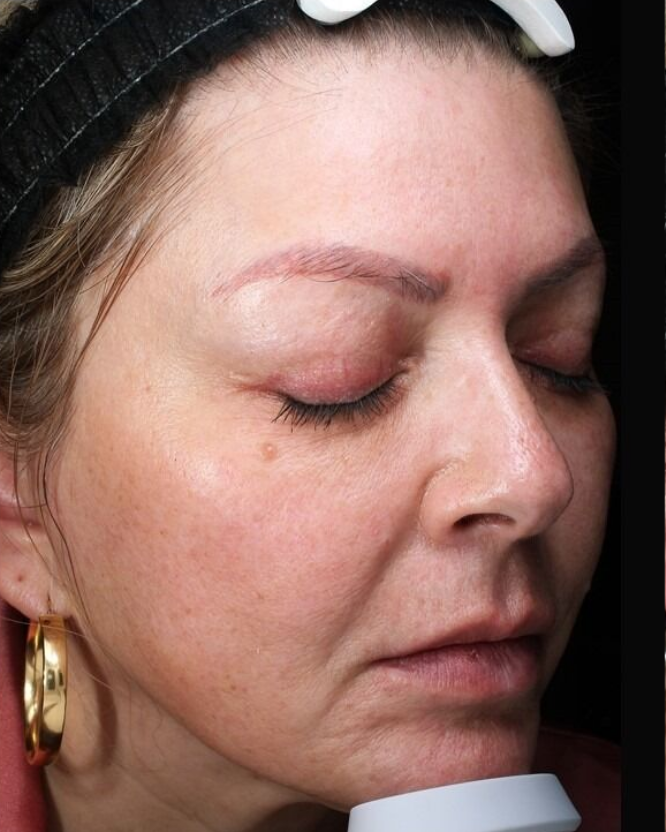 BBL Therapy Case 10 Before Image