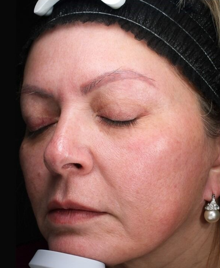 BBL Therapy Case 10 After Image