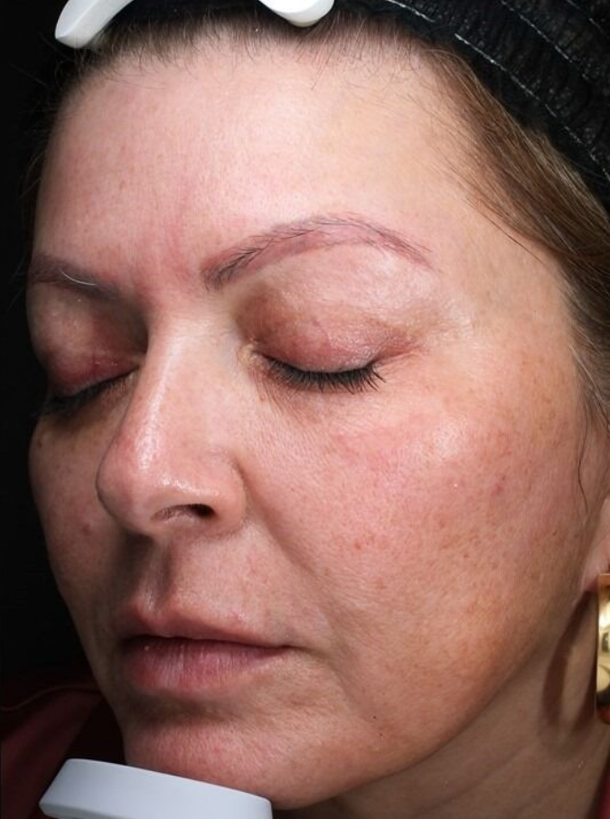 BBL Therapy Case 10 Before Image