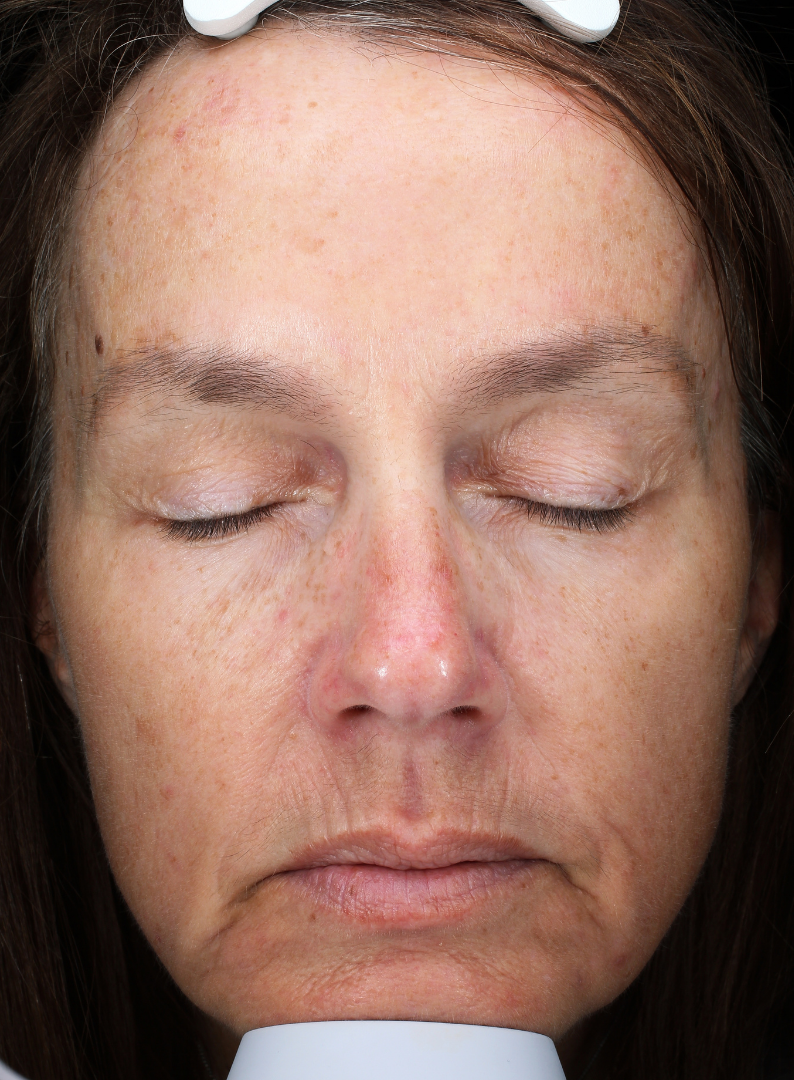 BBL Therapy Case 9 Before Image