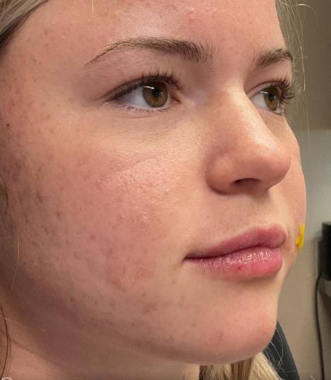 Dermal Fillers Case 65 After Image