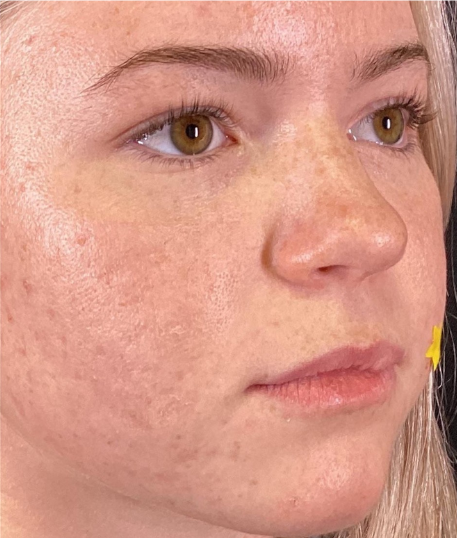 Dermal Fillers Case 65 Before Image