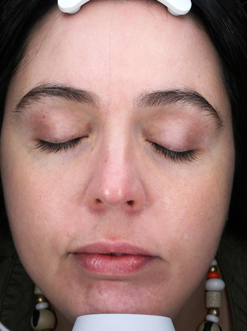 MOXI® Laser Case 1 After Image