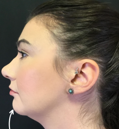 Dermal Fillers Case 45 After Image