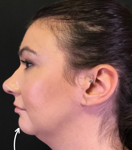 Dermal Fillers Case 45 Before Image