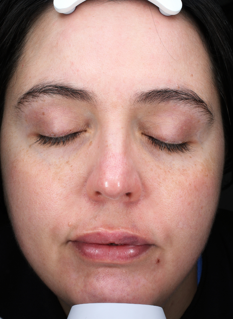 MOXI® Laser Case 1 Before Image