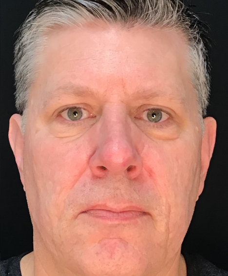 Dermal Fillers Case 60 After Image