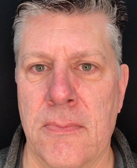 Dermal Fillers Case 60 Before Image