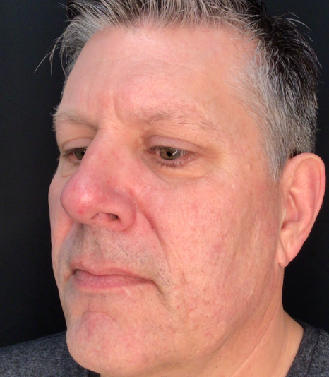 Dermal Fillers Case 60 After Image