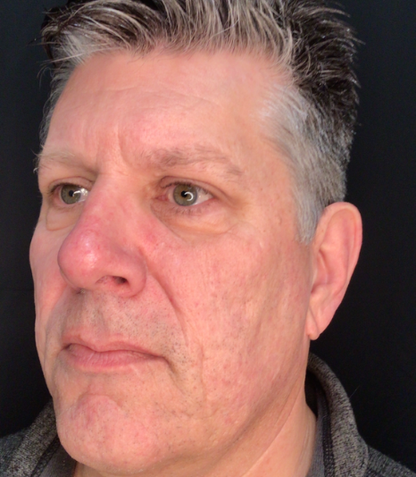 Dermal Fillers Case 60 Before Image