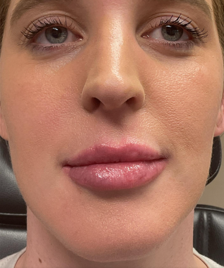 Dermal Fillers Case 61 After Image
