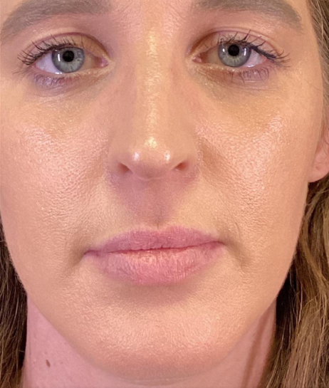 Dermal Fillers Case 61 Before Image