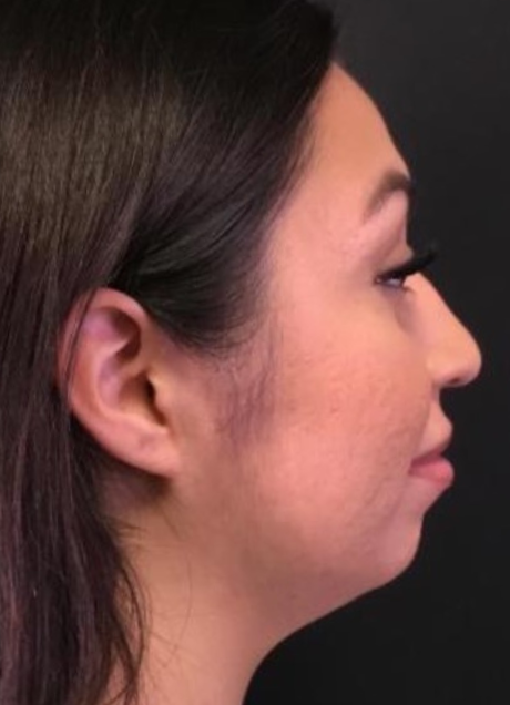 Coolsculpting® ELITE Case 38 After Image