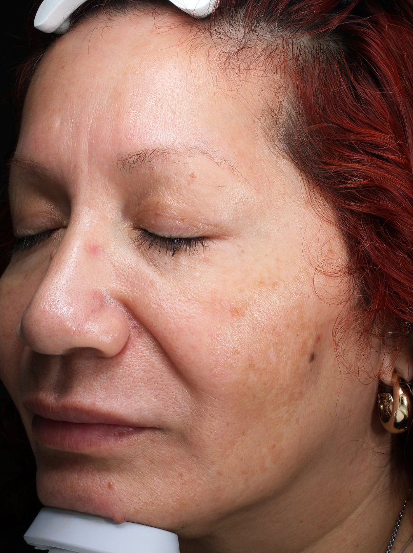 Chemical Peel Case 1 After Image