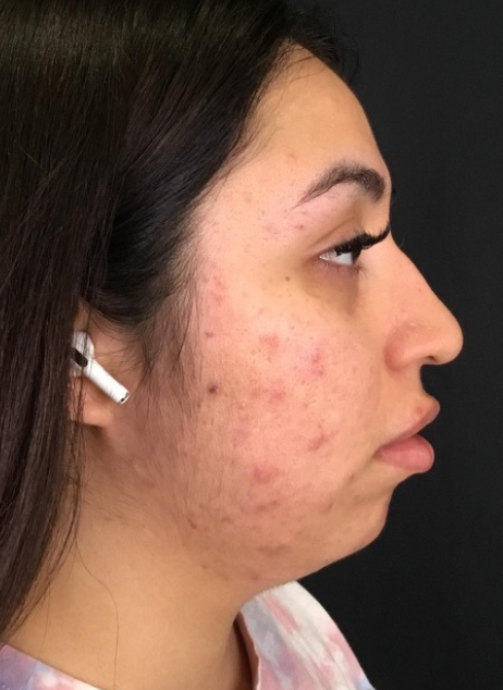 Coolsculpting® ELITE Case 38 Before Image