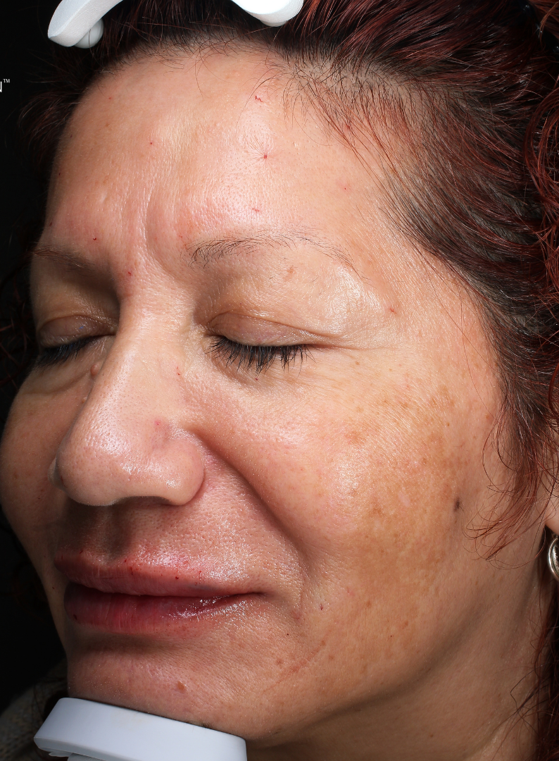 Chemical Peel Case 1 Before Image