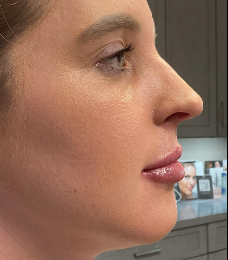 Dermal Fillers Case 58 After Image