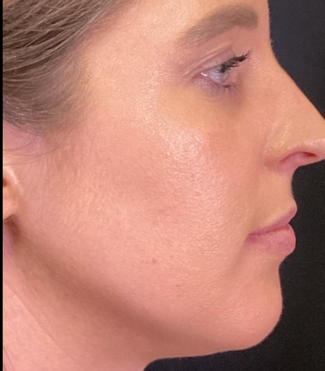 Dermal Fillers Case 58 Before Image