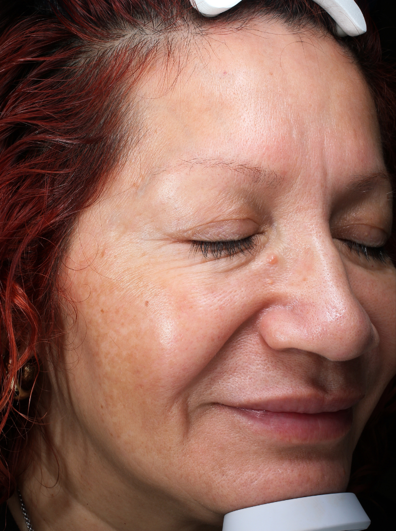 Chemical Peel Case 1 After Image