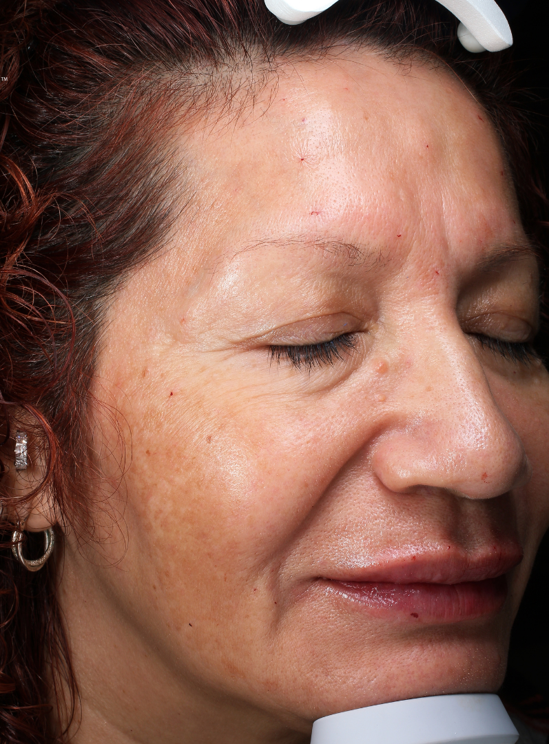Chemical Peel Case 1 Before Image