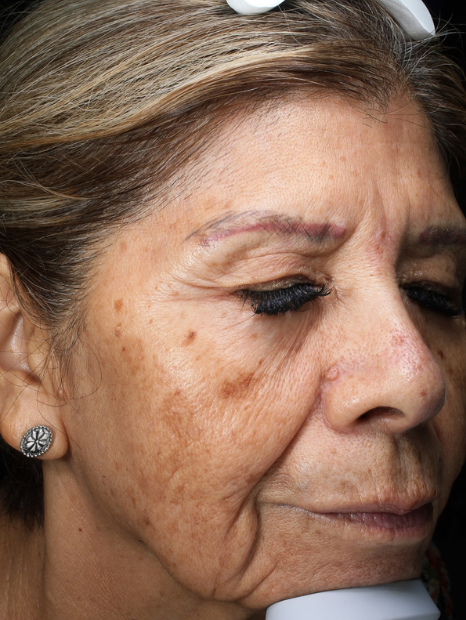 BBL Therapy Case 4 Before Image