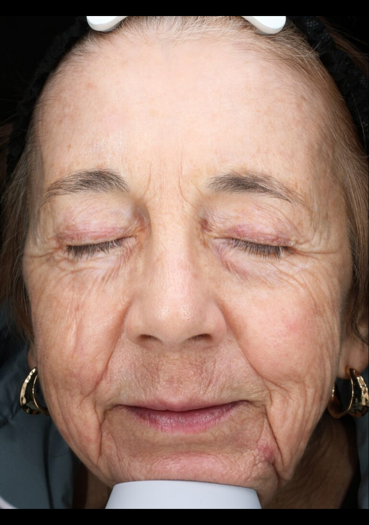 MOXI® Laser Case 2 After Image