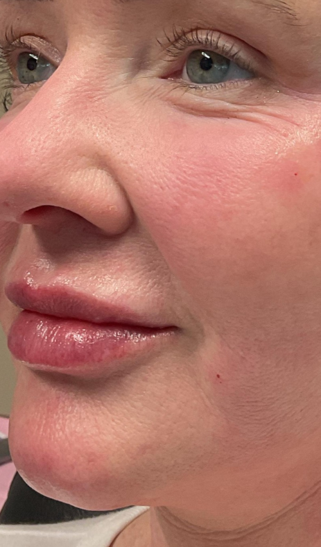 Dermal Fillers Case 62 After Image