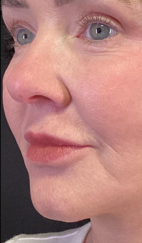 Dermal Fillers Case 62 Before Image