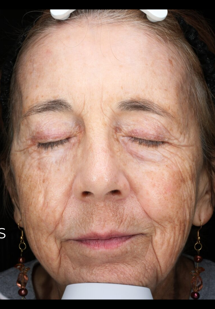 MOXI® Laser Case 2 Before Image