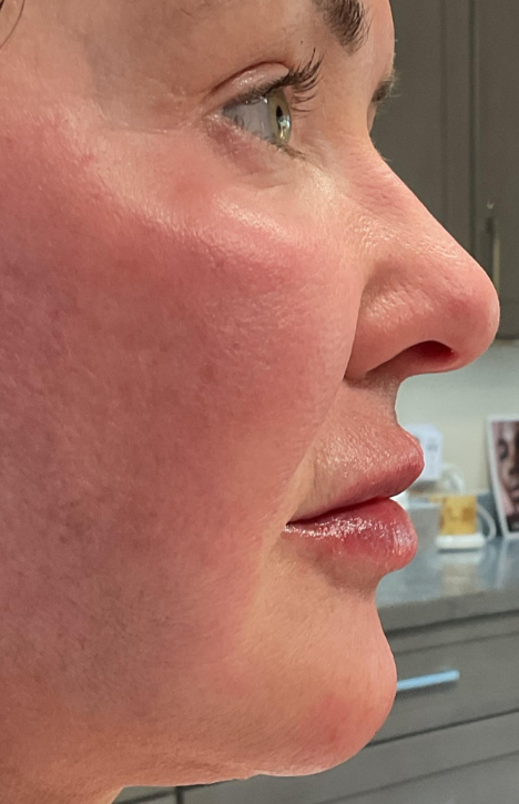 Dermal Fillers Case 56 After Image