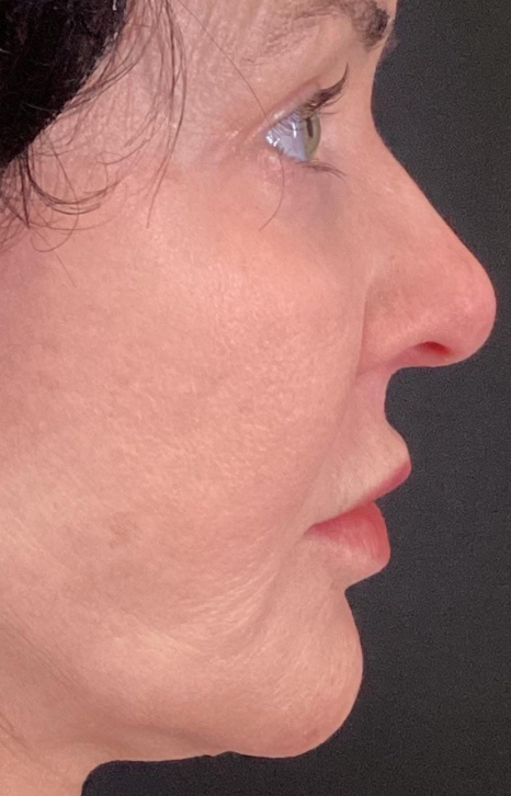 Dermal Fillers Case 56 Before Image