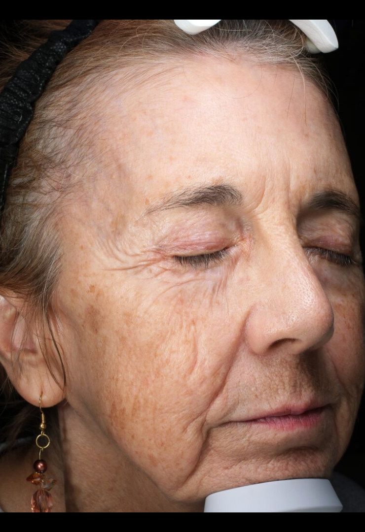 MOXI® Laser Case 2 Before Image