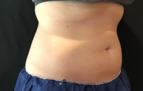Coolsculpting® ELITE Case 48 After Image