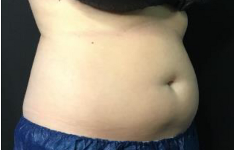 Coolsculpting® ELITE Case 48 Before Image