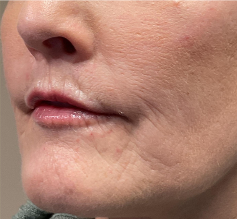 Dermal Fillers Case 57 After Image