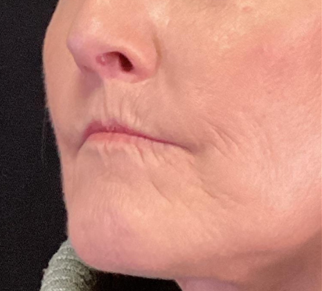 Dermal Fillers Case 57 Before Image