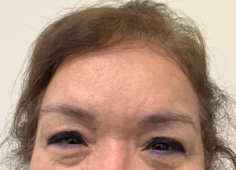 Botox® / Dysport® Case 23 After Image
