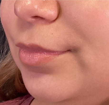 Dermal Fillers Case 52 Before Image