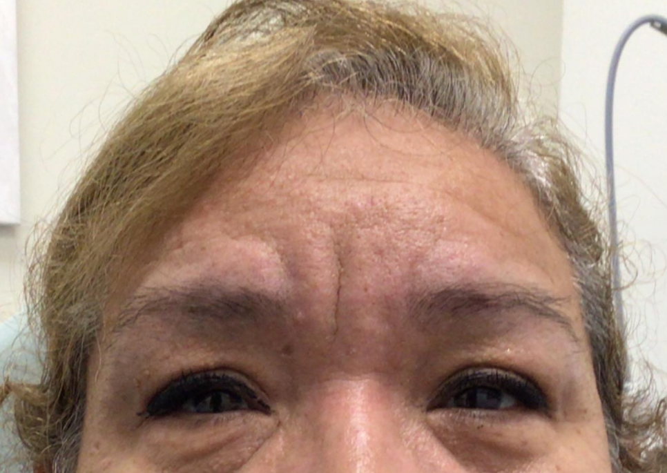Botox® / Dysport® Case 23 Before Image