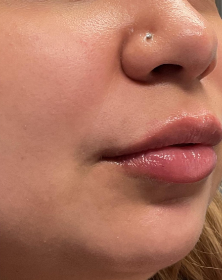 Dermal Fillers Case 54 After Image