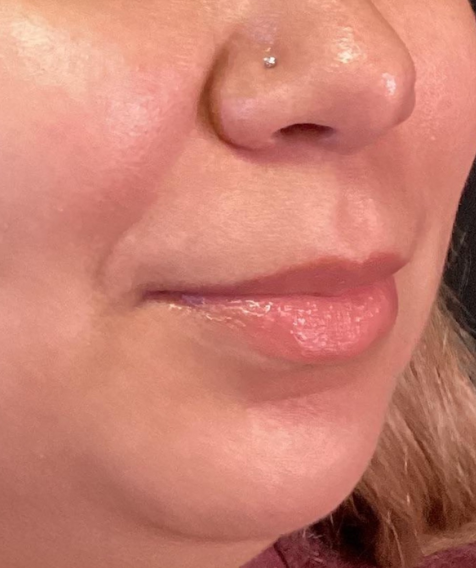 Dermal Fillers Case 54 Before Image